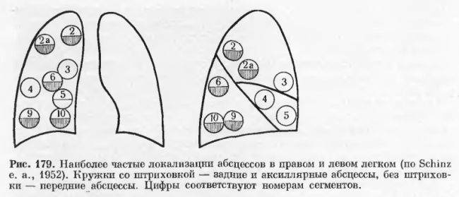 локализация абсцессов на рентгене легких